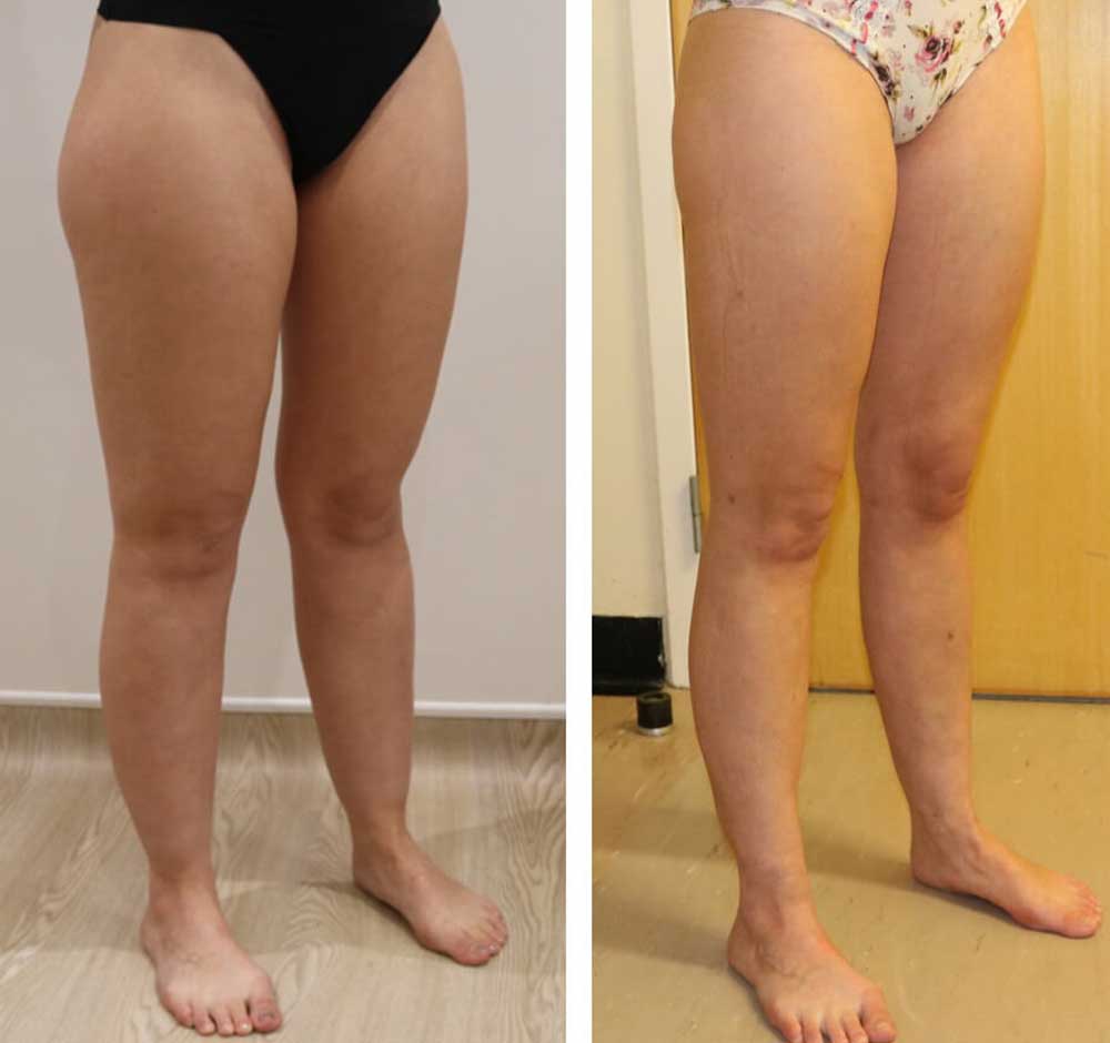 Lower-limb-liposculpture at The Karri Clinic