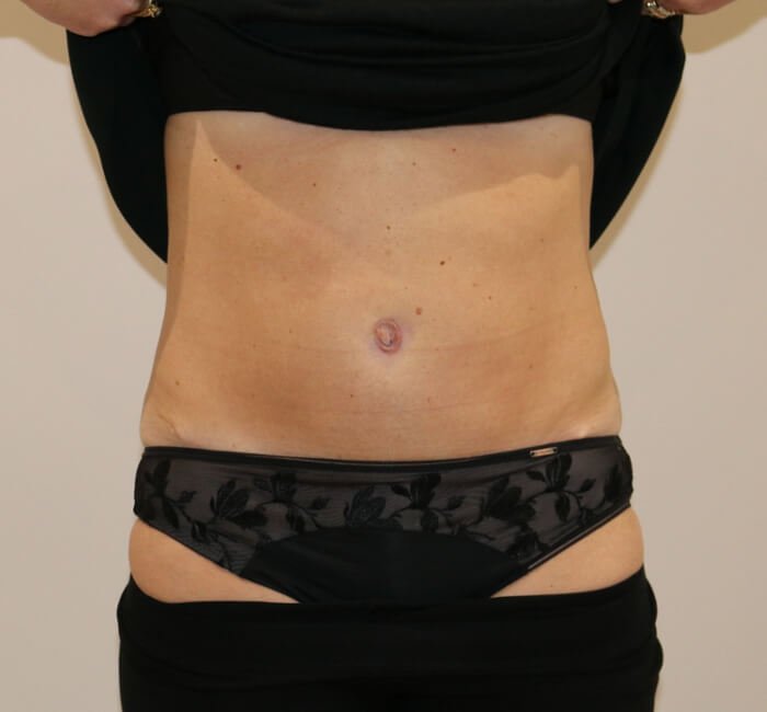 Tummy tuck abdominoplasty AP view after