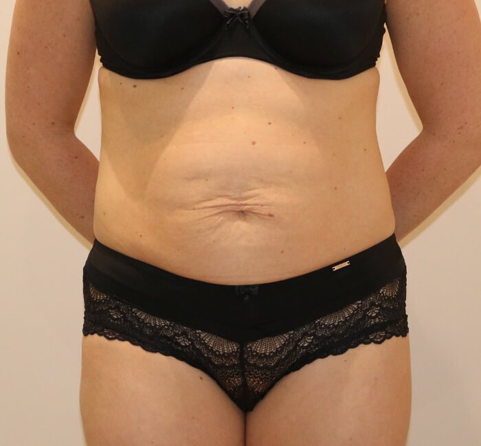 Tummy tuck abdominoplasty AP view before