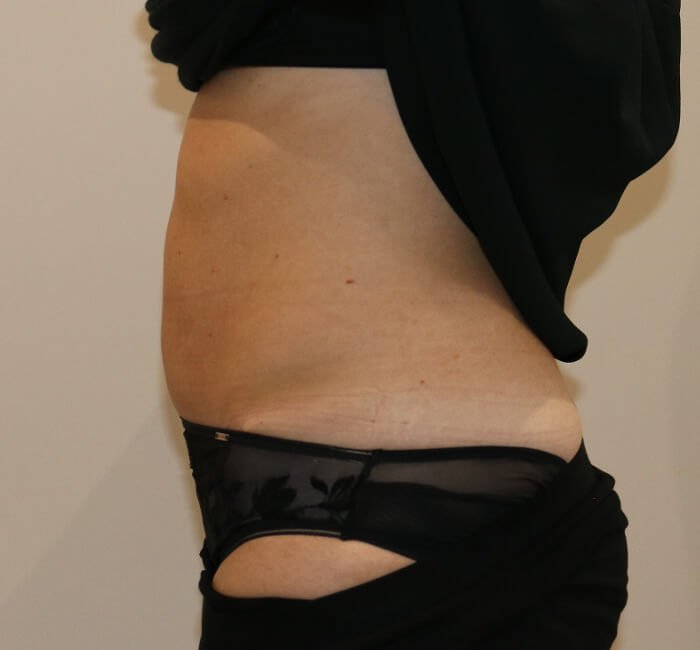 Tummy tuck abdominoplasty left lateral view after