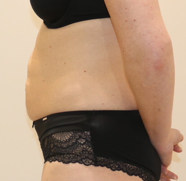 Tummy tuck abdominoplasty left lateral view before