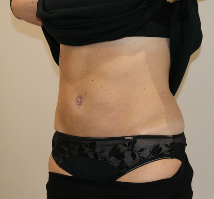 Tummy tuck abdominoplasty left oblique view after