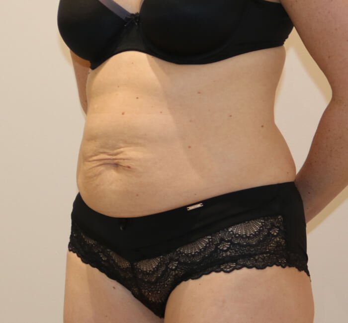 Tummy tuck abdominoplasty left oblique view before