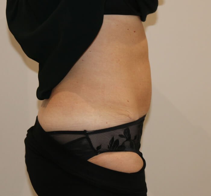 Tummy tuck abdominoplasty right lateral view after