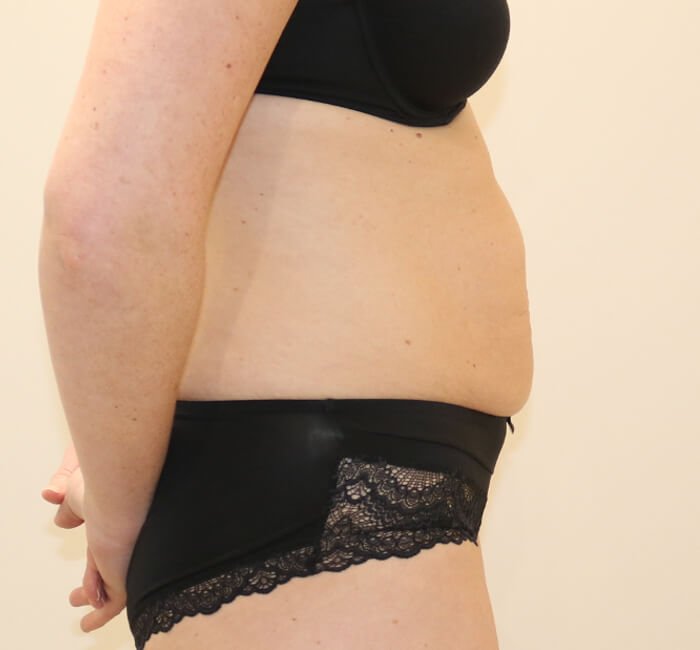Tummy tuck abdominoplasty right lateral view before