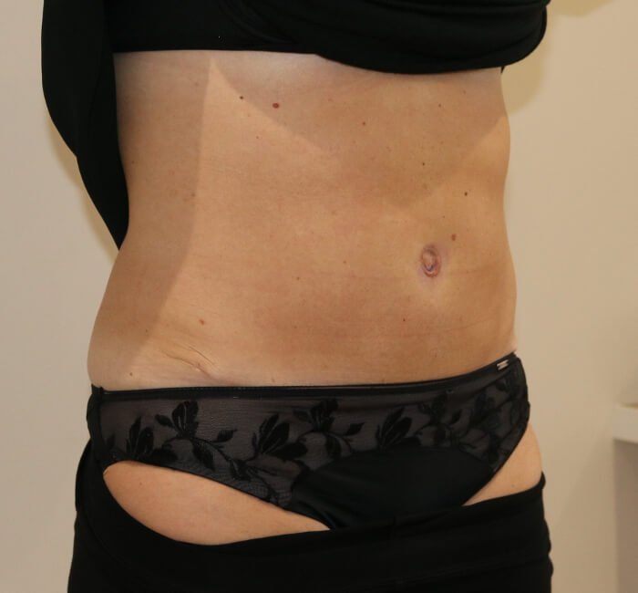 Tummy tuck abdominoplasty right oblique view after