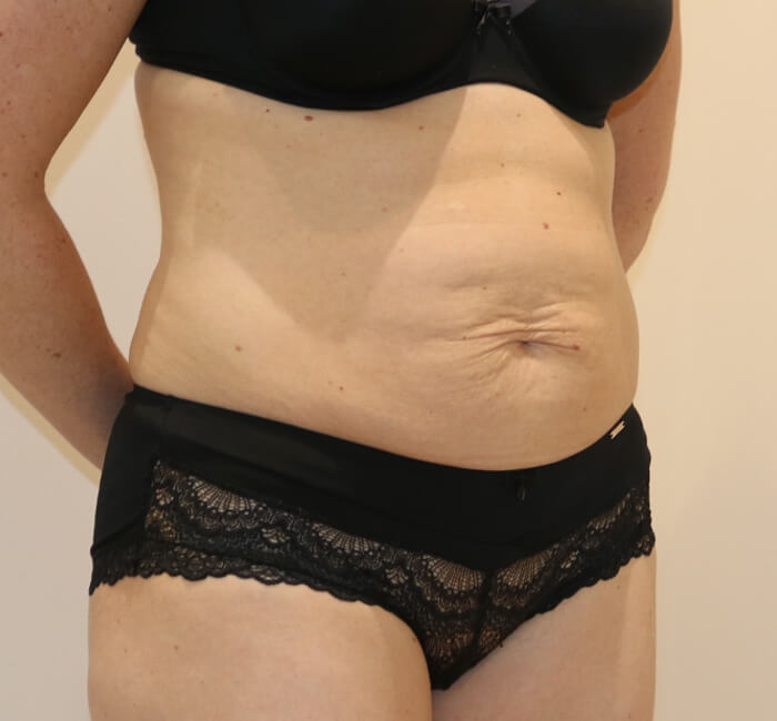 Tummy tuck abdominoplasty right oblique view before