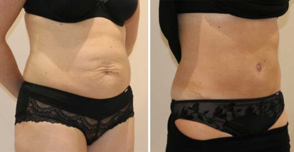 Tummy-tuck-daycase_The-Karri-Clinic2