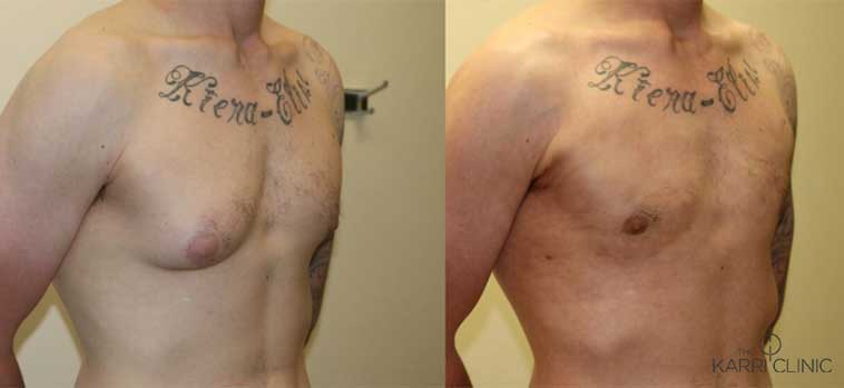 Unique-Gynaecomastia_The-Karri-Clinic