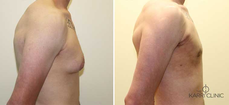 gynecomastia