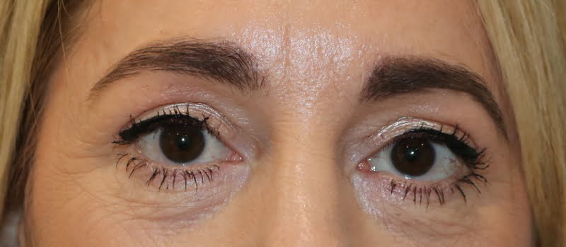 Upper blepharoplasty after surgery AP view