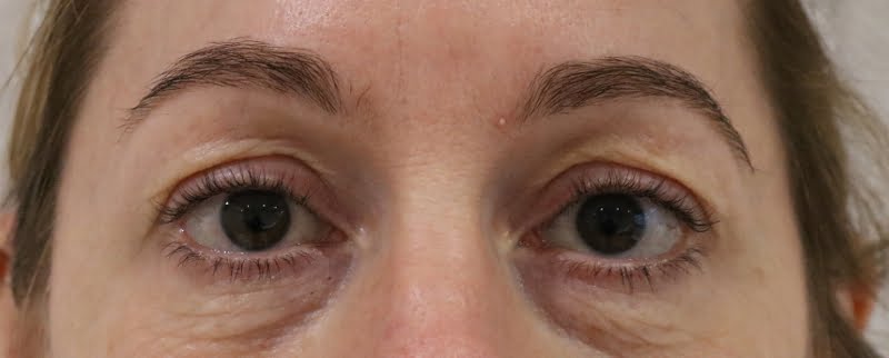 Upper blepharoplasty before surgery AP view