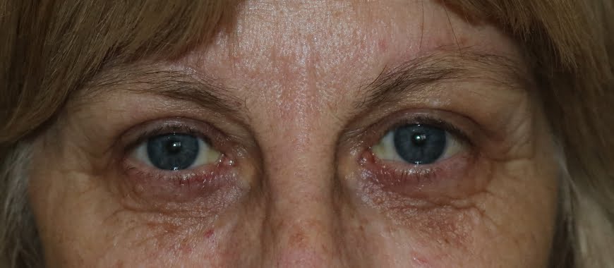 Direct brow lift and upper eyelid lift blepharoplasty after surgery AP view