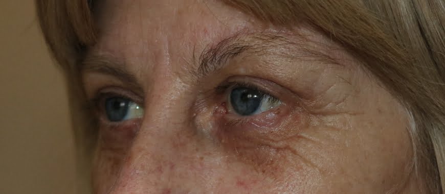 Direct brow lift and upper eyelid lift blepharoplasty after surgery left oblique view