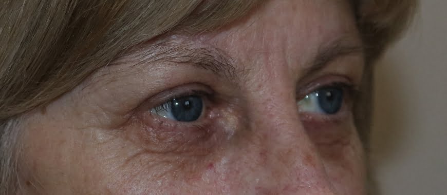 Direct brow lift and upper eyelid lift blepharoplasty after surgery right oblique view