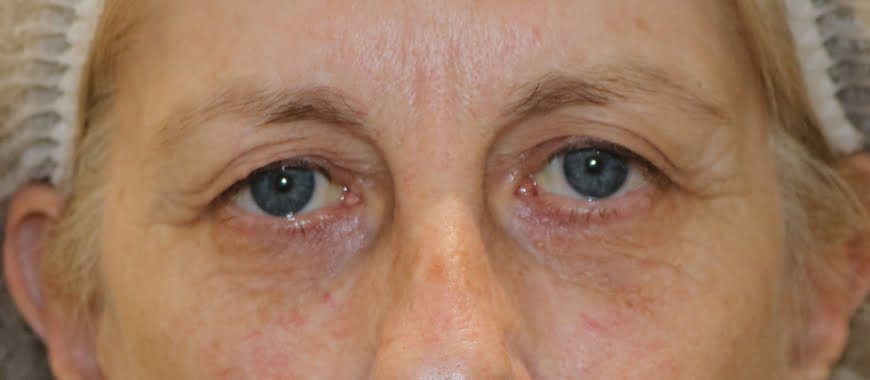 Direct brow lift and upper eyelid lift blepharoplasty before surgery AP view