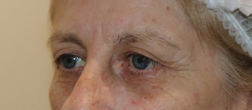 Direct brow lift and upper eyelid lift blepharoplasty before surgery left oblique view