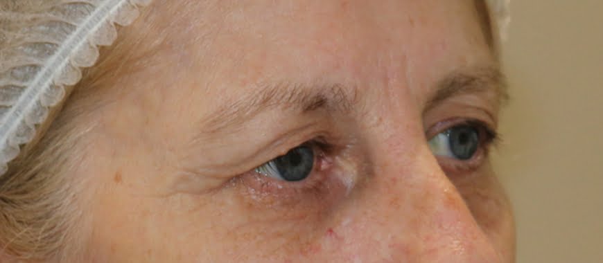 Direct brow lift and upper eyelid lift blepharoplasty before surgery right oblique view