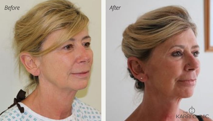 Facelift at The Karri Clinic