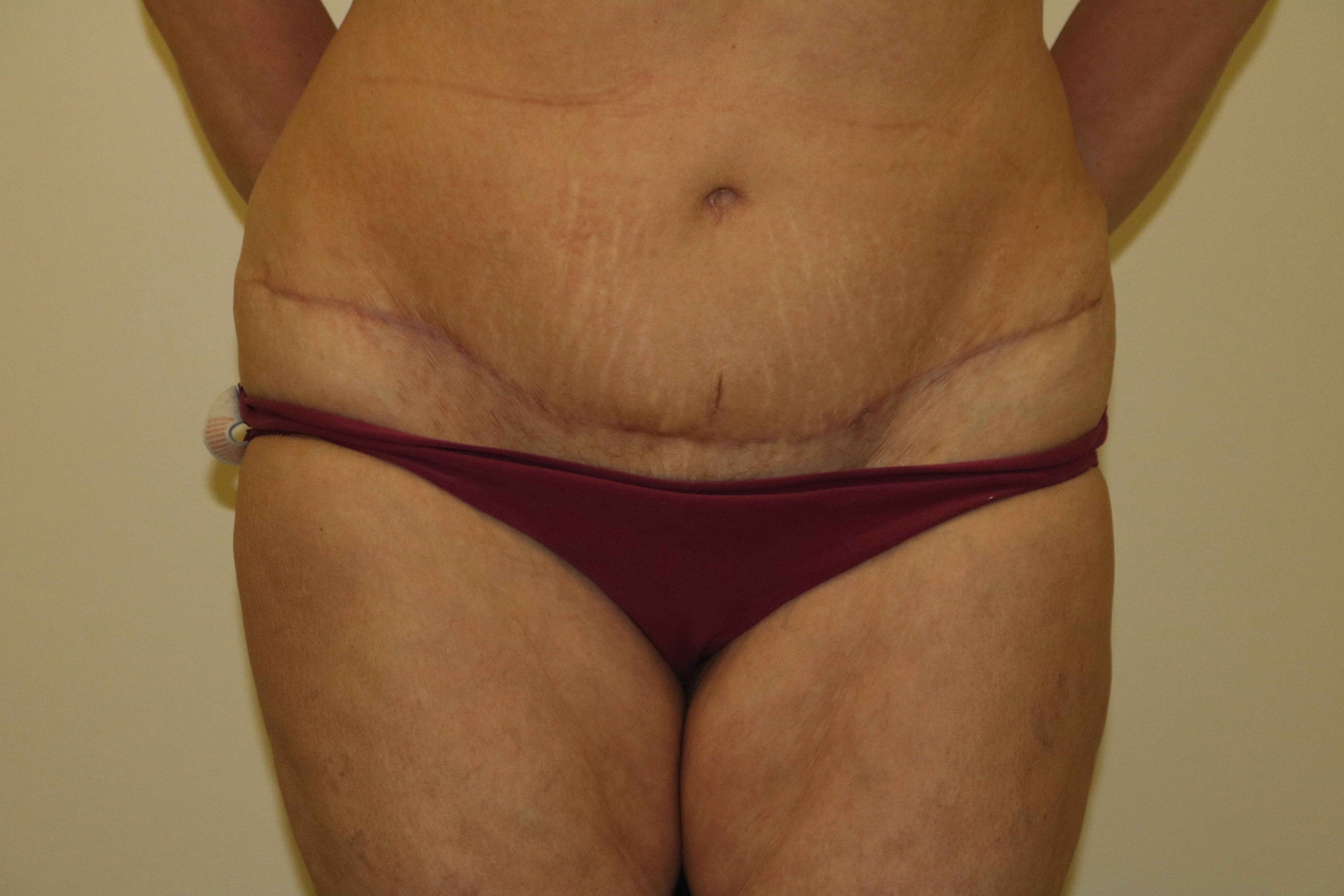 Mummy makeover Brazilian tummy tuck scar