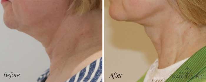 Necklift at The Karri Clinic