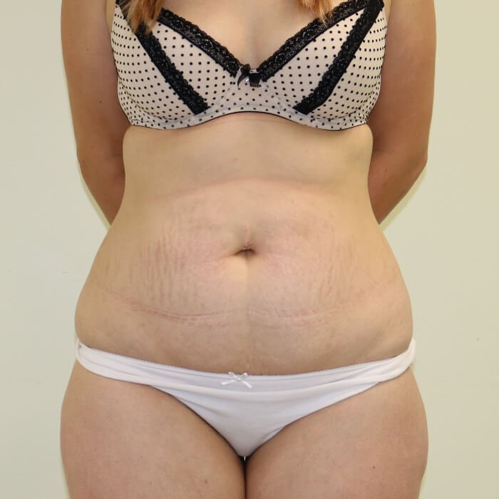 Tummy tuck AP view before surgery