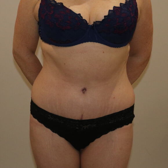Tummy tuck after surgery AP view