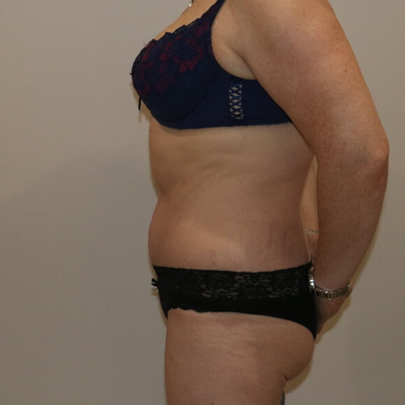 Tummy tuck after surgery left lateral view