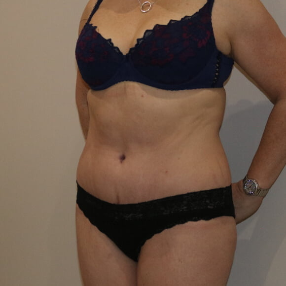 Tummy tuck after surgery left oblique view