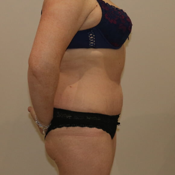 Tummy tuck after surgery right lateral view
