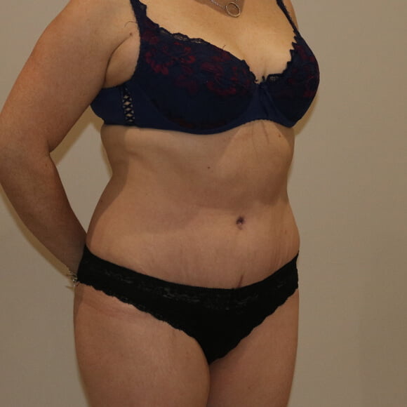 Tummy tuck after surgery right oblique view