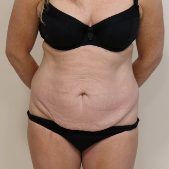 Tummy tuck before surgery AP view