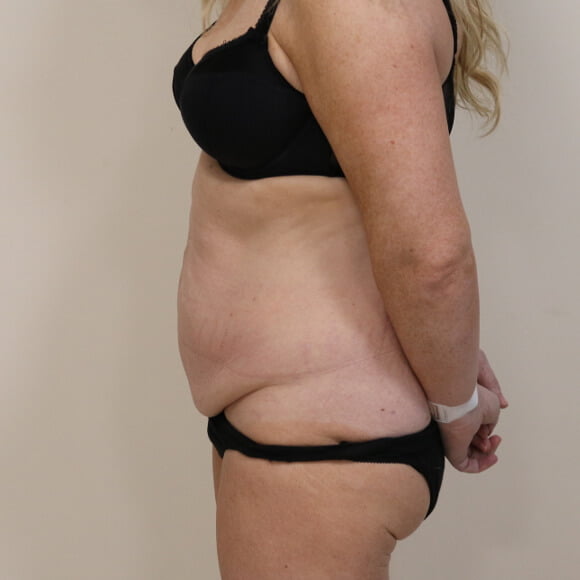 Tummy tuck before surgery left lateral view