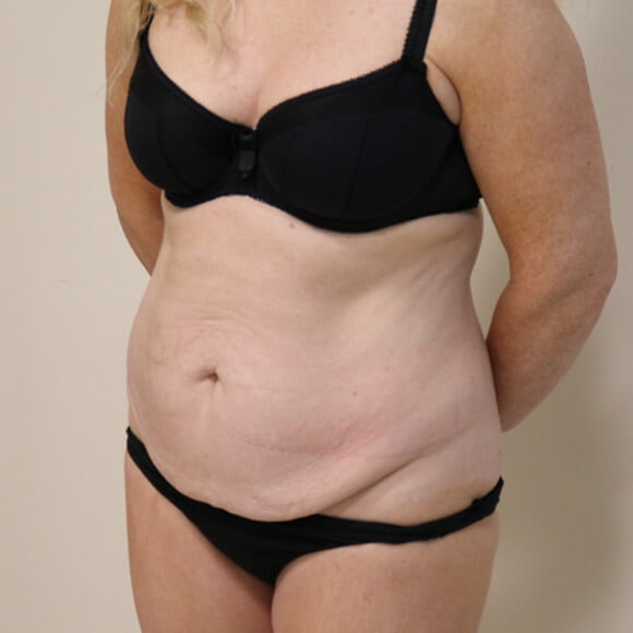 Tummy tuck before surgery left oblique view