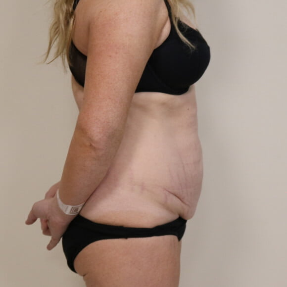 Tummy tuck before surgery right lateral view