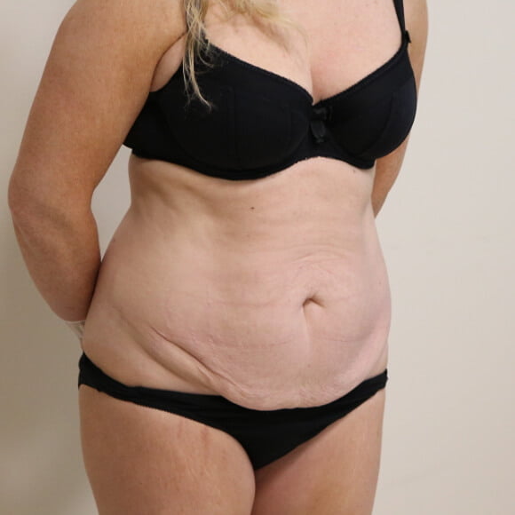 Tummy tuck before surgery right oblique view