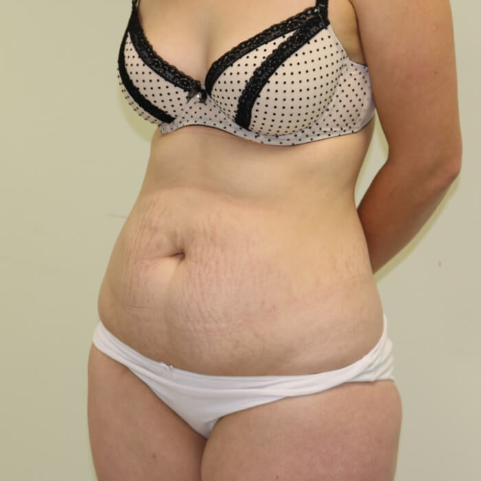 Tummy tuck left oblique view before surgery
