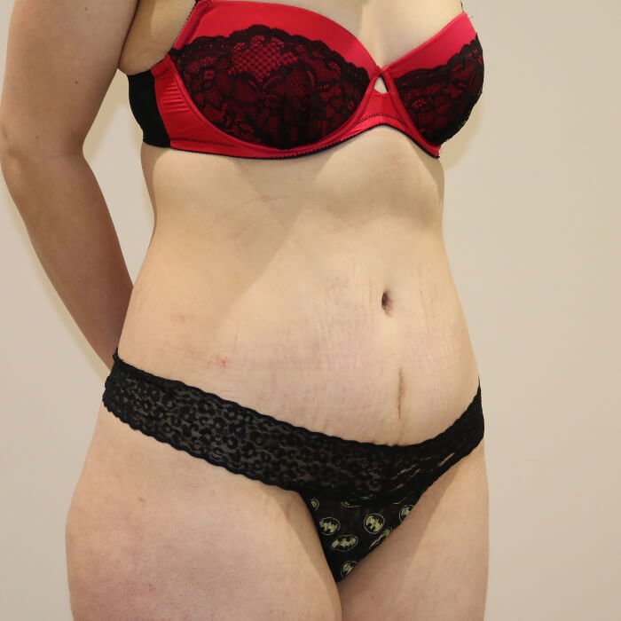 Tummy tuck right oblique view after surgery