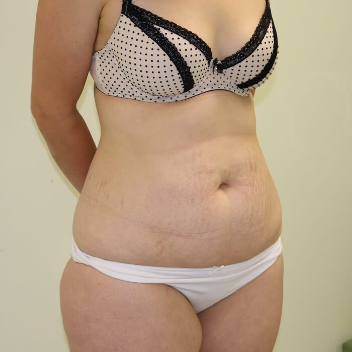 Tummy tuck right oblique view before surgery