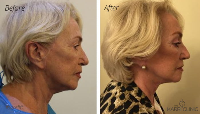Facelift at The Karri Clinic