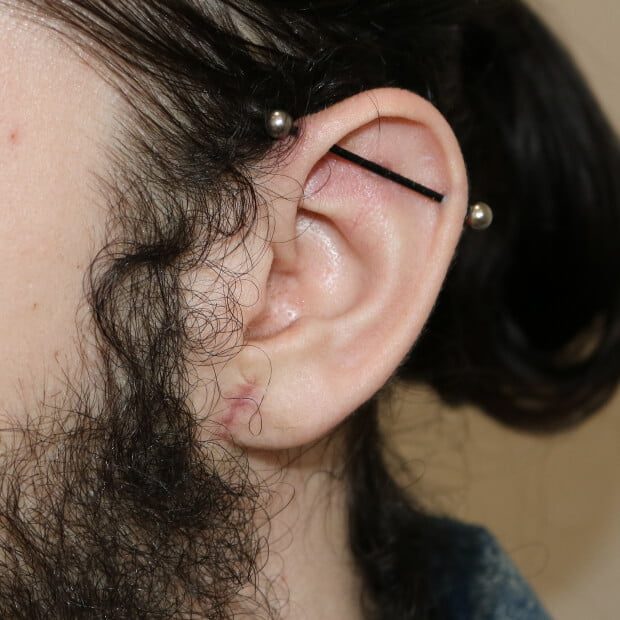 Left tribal earlobe repair after surgery