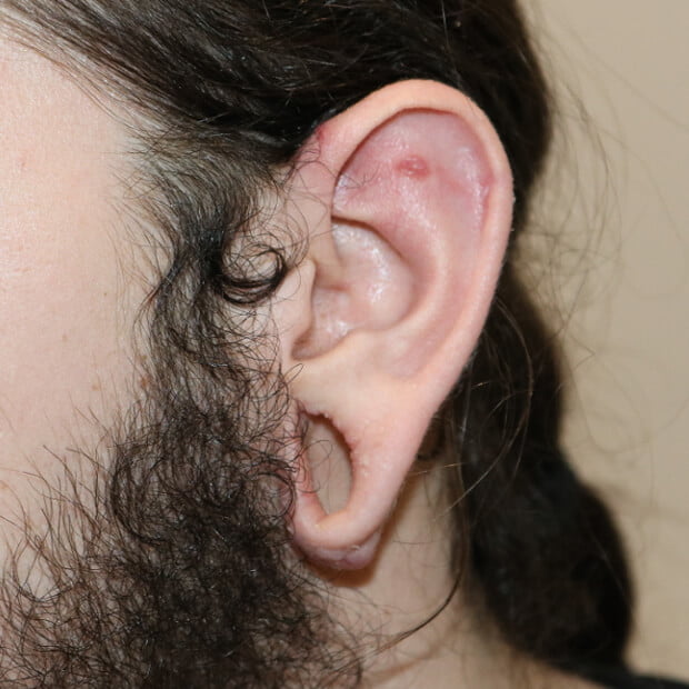 Left tribal earlobe repair before surgery