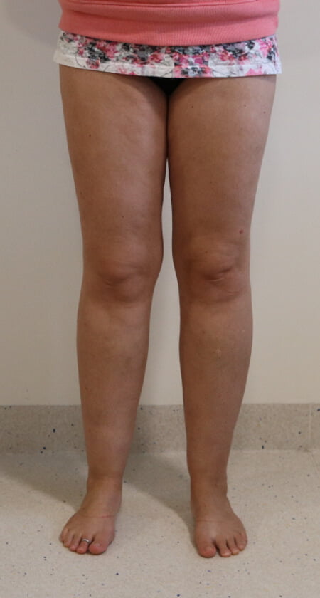 Lower limb lipoedema liposuction AP view before surgery