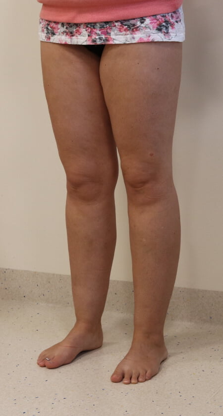 Lower limb lipoedema liposuction left oblique view before surgery
