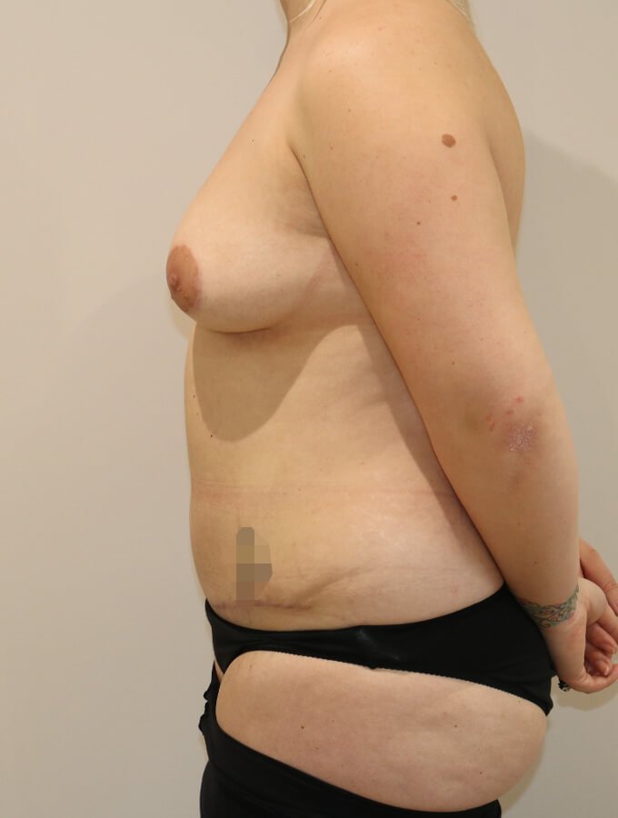 Mummy makeover breast fat grafting mastopexy Brazilian tummy tuck after surgery left lateral view