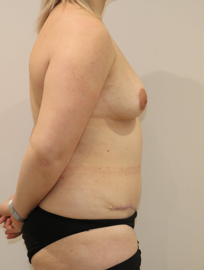 Mummy makeover breast fat grafting mastopexy Brazilian tummy tuck after surgery right lateral view