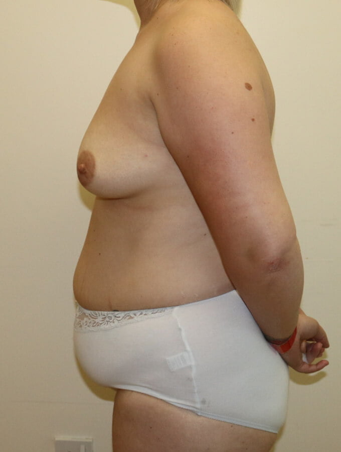 Mummy makeover breast fat grafting mastopexy Brazilian tummy tuck before surgery left lateral view