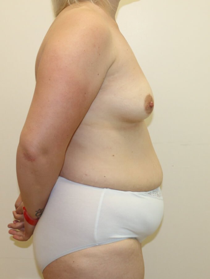 Mummy makeover breast fat grafting mastopexy Brazilian tummy tuck before surgery right lateral view