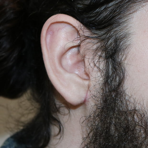 Right tribal earlobe repair after surgery