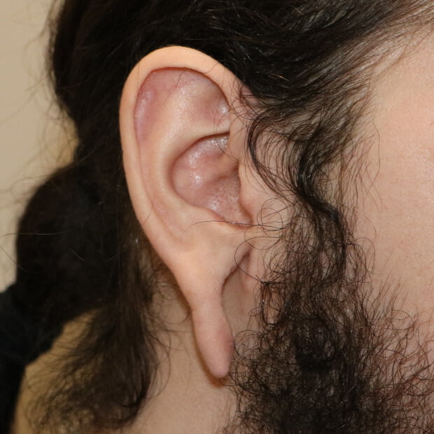 Right tribal earlobe repair before surgery